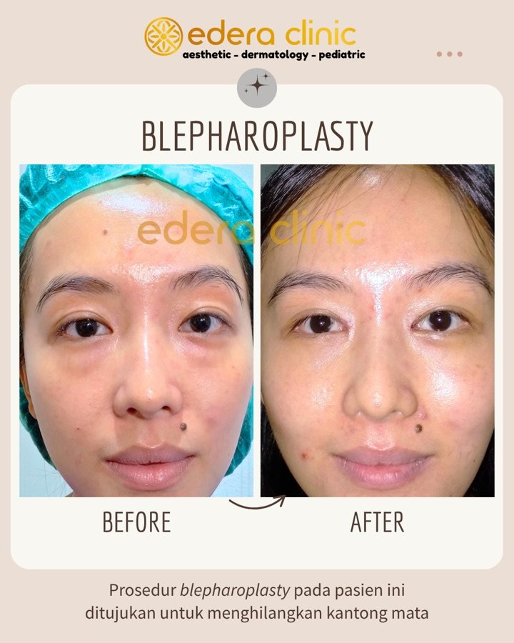 Before/after prosedur Blepharoplasty di Edera Clinic