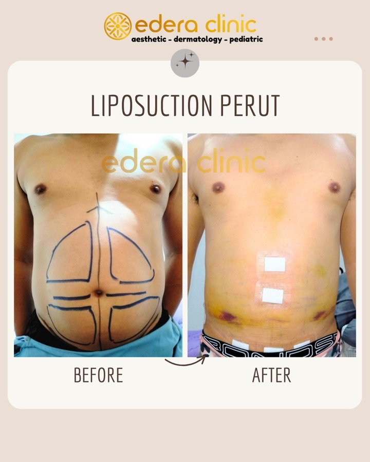 Before/after prosedur Liposuction di Edera Clinic